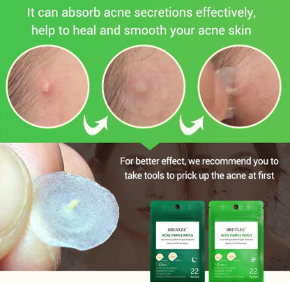 Breylee ClearDots™ Tea Tree Acne Patches